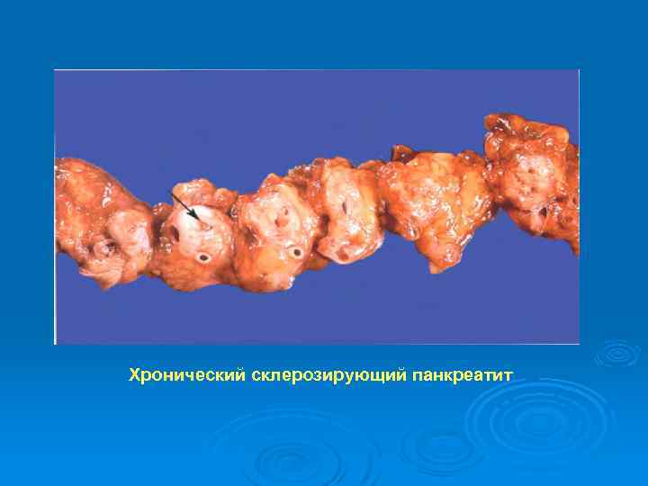 Хронический склерозирующий панкреатит 