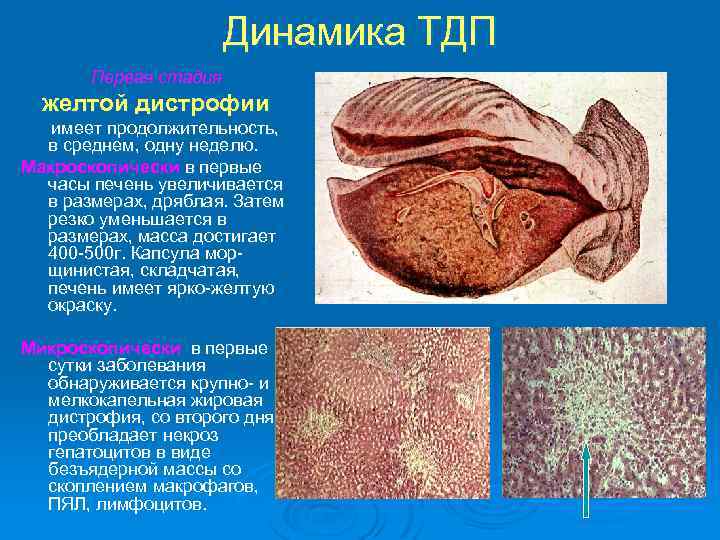 Динамика ТДП Первая стадия желтой дистрофии имеет продолжительность, в среднем, одну неделю. Макроскопически в