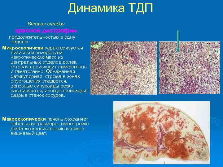 Динамика ТДП Вторая стадия красной дистрофии продолжительностью в одну неделю Микроскопичеки характеризуется лизисом и