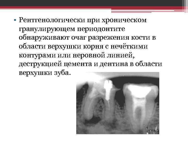  • Рентгенологически при хроническом гранулирующем периодонтите обнаруживают очаг разрежения кости в области верхушки