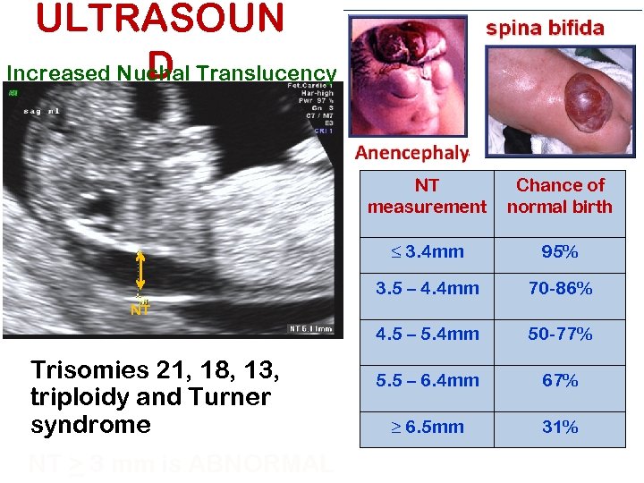 ULTRASOUN D Increased Nuchal Translucency NT measurement Chance of normal birth ≤ 3. 4