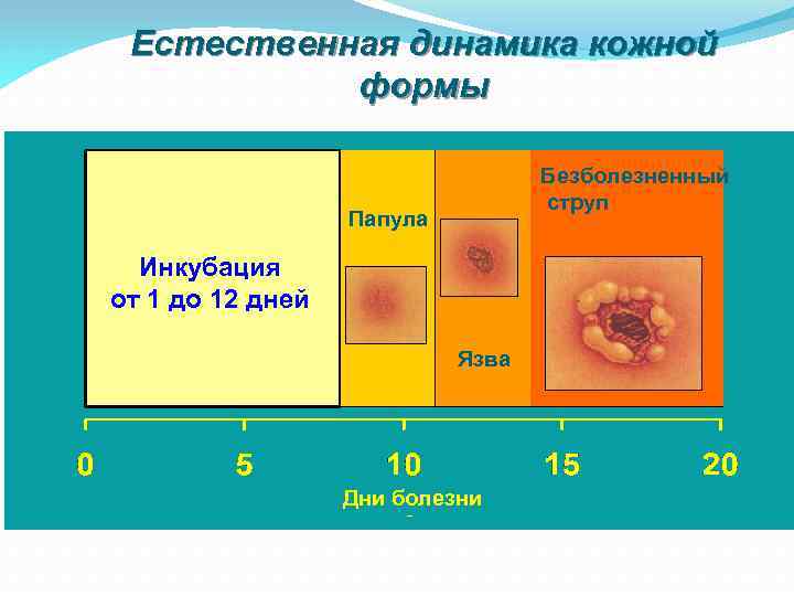 Естественная динамика кожной формы Безболезненный струп Папула Инкубация от 1 дo 12 дней Язва