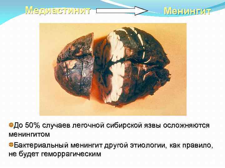 Медиастинит Менингит До 50% случаев легочной сибирской язвы осложняются менингитом Бактериальный менингит другой этиологии,