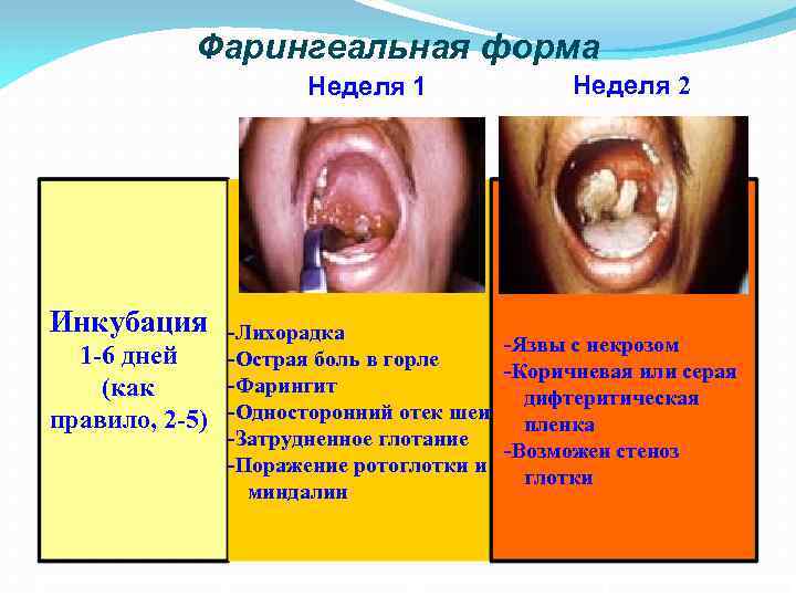 Фарингеальная форма Неделя 1 Инкубация 1 -6 дней (как правило, 2 -5) Неделя 2