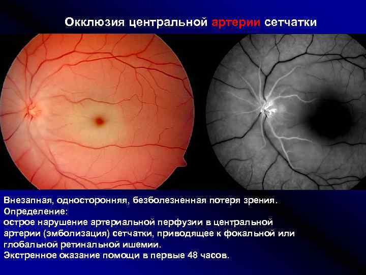 У близоруких людей изображение фокусируется перед сетчаткой на сосудистой