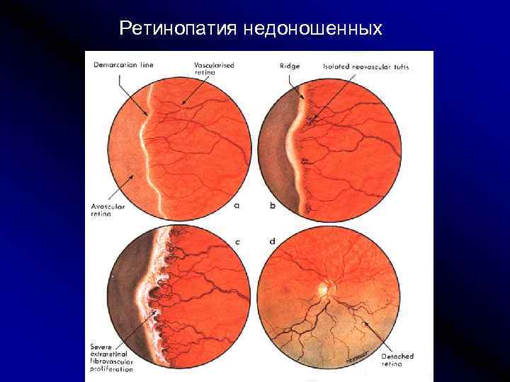 Ретинопатия недоношенных 