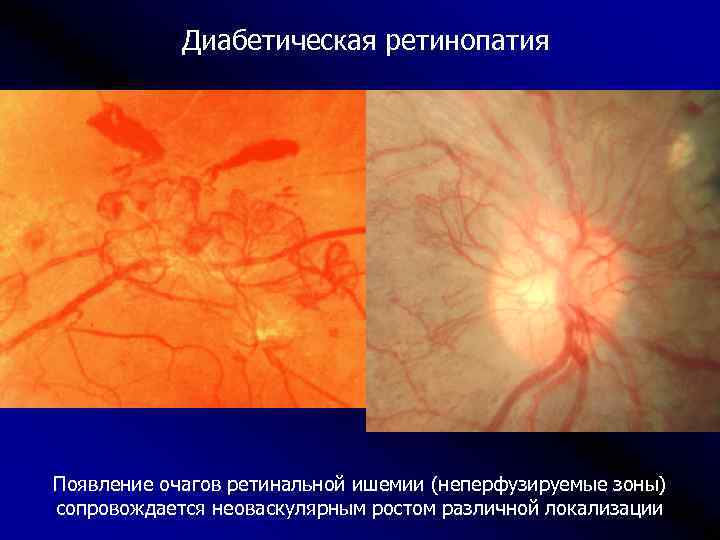 Диабетическая ретинопатия Появление очагов ретинальной ишемии (неперфузируемые зоны) сопровождается неоваскулярным ростом различной локализации 