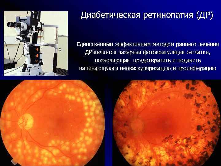 Лечение диабетической ретинопатии. Диабетическая ретинопатия. Диабетической ретинопатии. Профилактика диабетической ретинопатии. Стадии диабетической ретинопатии.