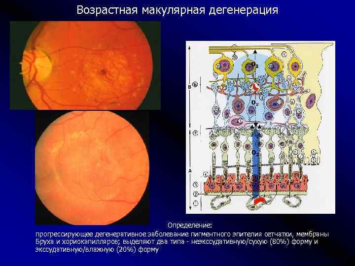 Возрастная макулярная дегенерация презентация