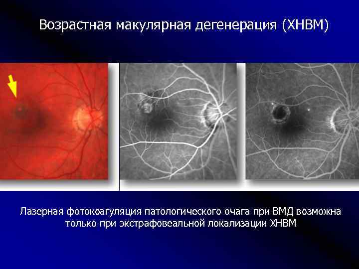 Возрастная макулярная дегенерация (ХНВМ) Лазерная фотокоагуляция патологического очага при ВМД возможна только при экстрафовеальной