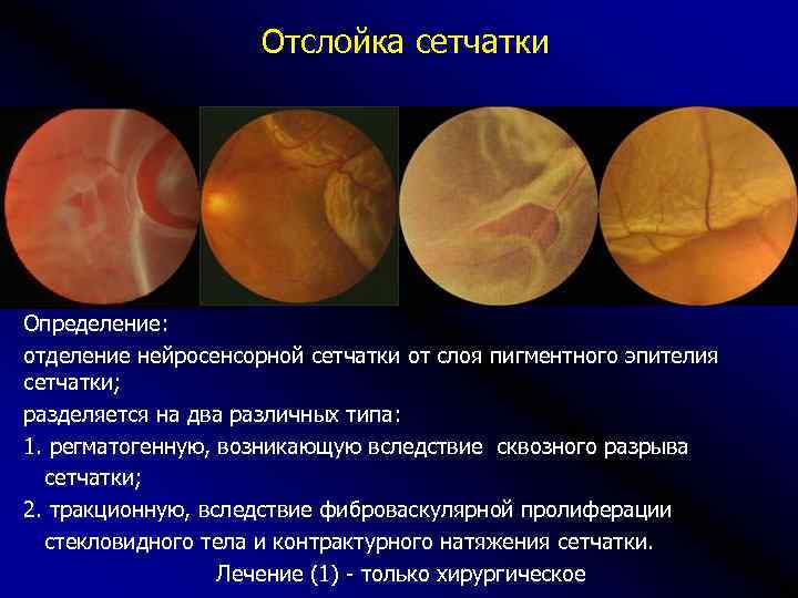 Презентация на тему отслойка сетчатки