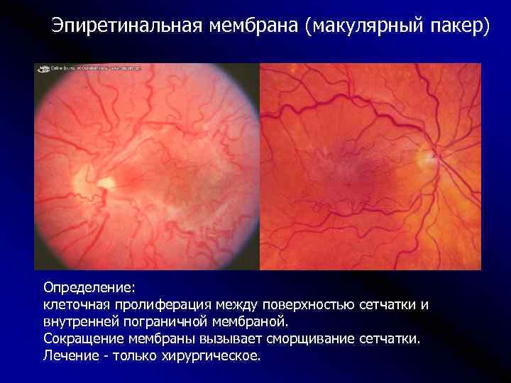Эпиретинальная мембрана (макулярный пакер) Определение: клеточная пролиферация между поверхностью сетчатки и внутренней пограничной мембраной.