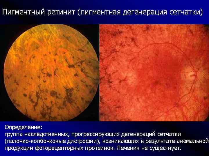 Пигментный ретинит (пигментная дегенерация сетчатки) Определение: группа наследственных, прогрессирующих дегенераций сетчатки (палочко-колбочковые дистрофии), возникающих