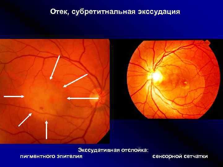 Презентация на тему отслойка сетчатки