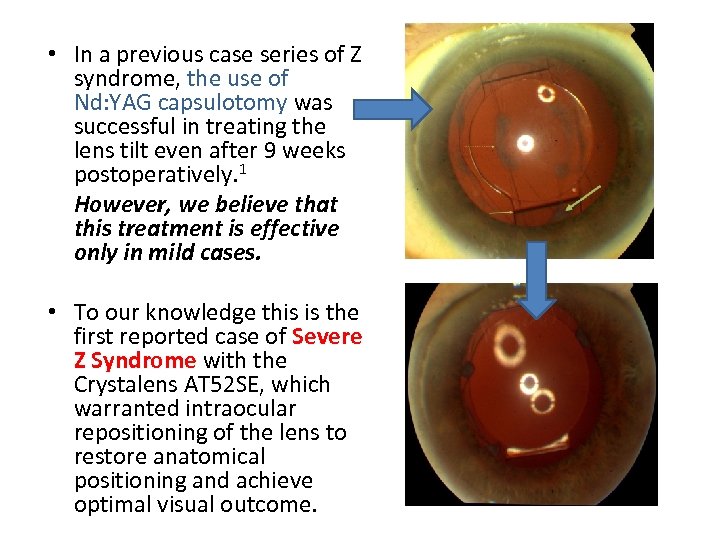  • In a previous case series of Z syndrome, the use of Nd: