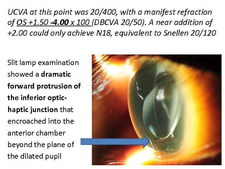 UCVA at this point was 20/400, with a manifest refraction of OS +1. 50