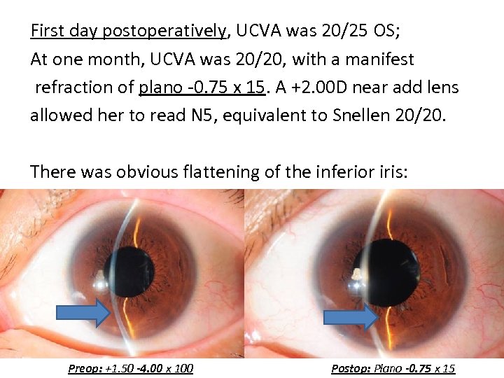 First day postoperatively, UCVA was 20/25 OS; At one month, UCVA was 20/20, with