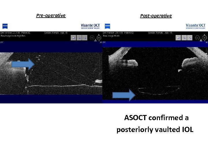 Pre-operative Post-operative ASOCT confirmed a posteriorly vaulted IOL 