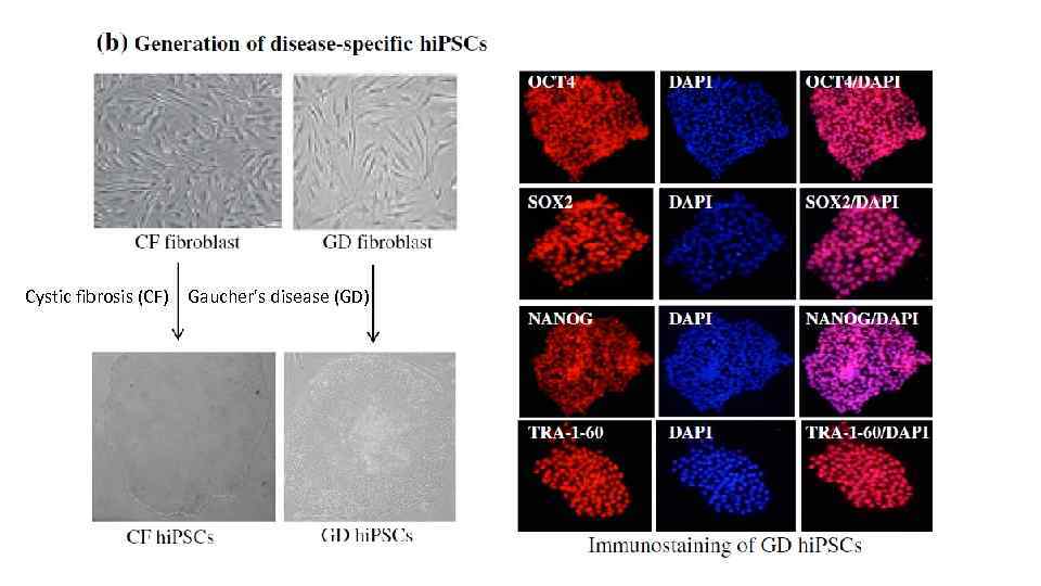 Cystic fibrosis (CF) Gaucher's disease (GD) 