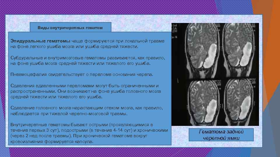 Виды внутричерепных гематом Эпидуральные гематомы чаще формируются при локальной травме на фоне легкого ушиба