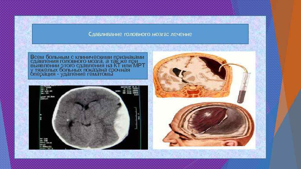 Сдавливание головного мозга: лечение Всем больным с клиническими признаками сдавления головного мозга, а так