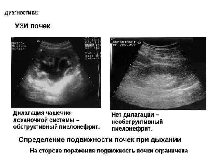 Расширенная чашечно лоханочная система. Чашечно-лоханочная система почки на УЗИ. Расширение чашечно-лоханочной системы почек на УЗИ. Расширение ЧЛС по УЗИ. Расширение ЧЛС почек на УЗИ.