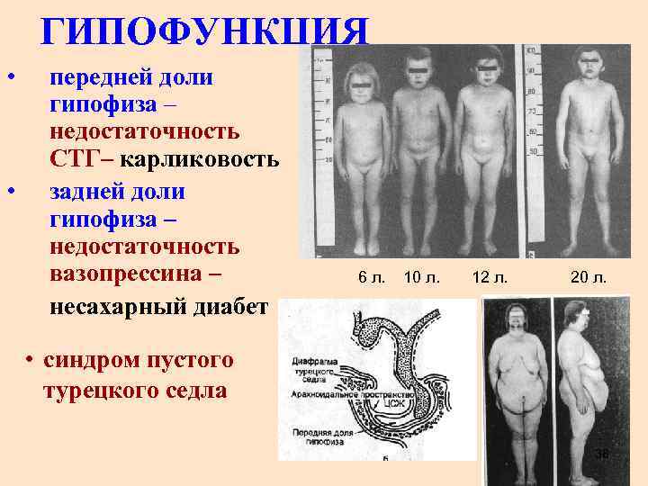 ГИПОФУНКЦИЯ • • передней доли гипофиза – недостаточность СТГ– карликовость задней доли гипофиза –