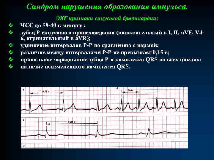 Синдром нарушения образования импульса. v v v ЭКГ признаки синусовой брадикардии: ЧСС до 59