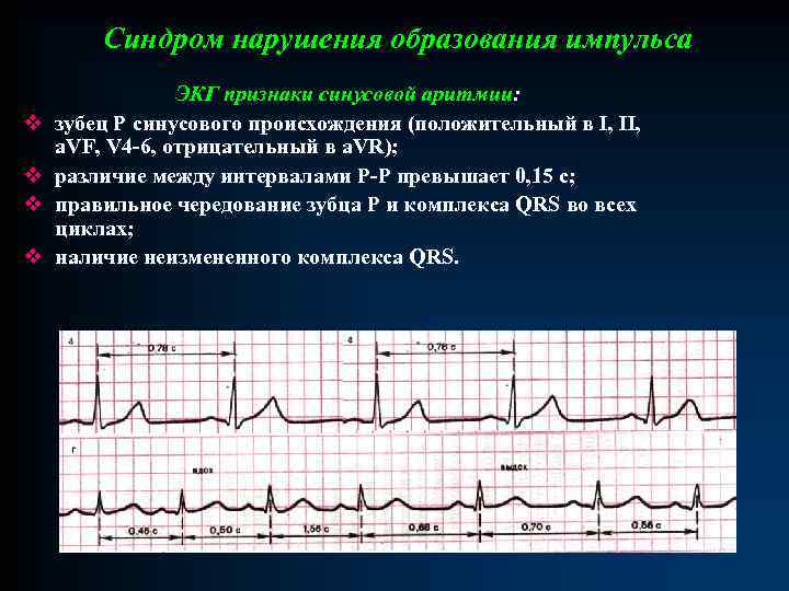 Синдром нарушения образования импульса v v ЭКГ признаки синусовой аритмии: зубец Р синусового происхождения