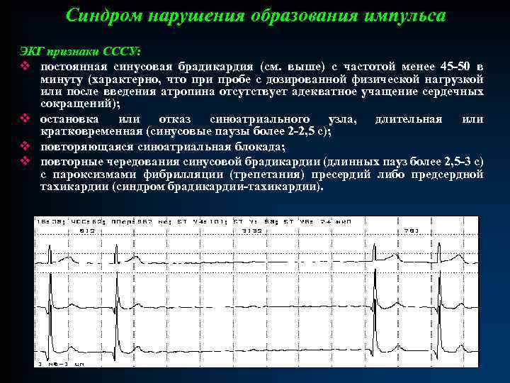 Патологии экг презентация