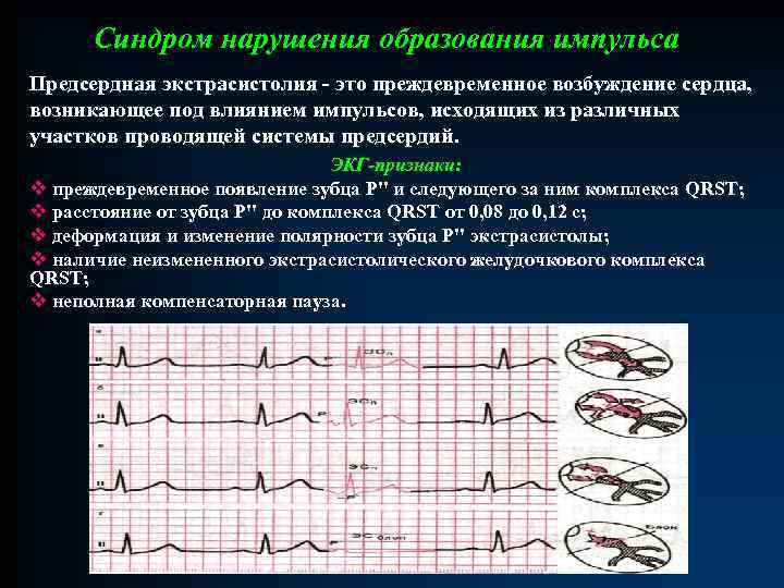 Синдром нарушения образования импульса Предсердная экстрасистолия - это преждевременное возбуждение сердца, возникающее под влиянием