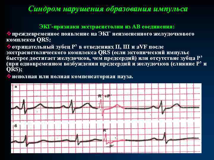 Синдром нарушения образования импульса ЭКГ-признаки экстрасистолии из АВ соединения: vпреждевременное появление на ЭКГ неизмененного