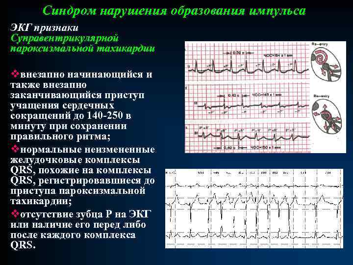 Пароксизмальная мерцательная аритмия карта вызова смп