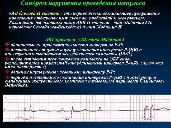 Синдром нарушения проведения импульса n. АВ блокада II степени - это периодически возникающее прекращение