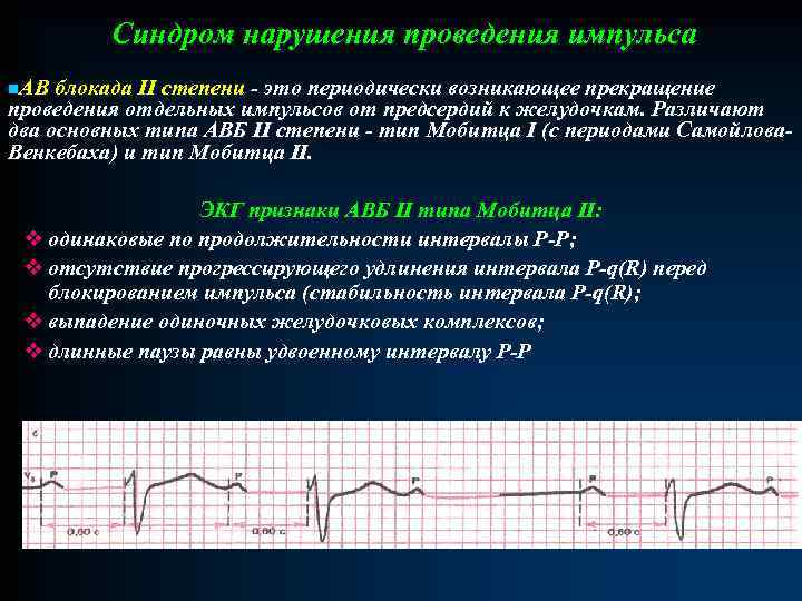 Синдром нарушения проведения импульса n. АВ блокада II степени - это периодически возникающее прекращение