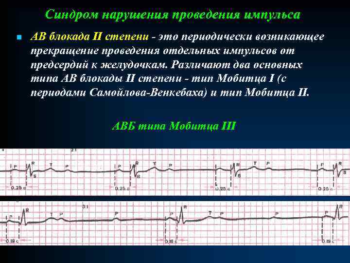 Синдром нарушения проведения импульса n АВ блокада II степени - это периодически возникающее прекращение