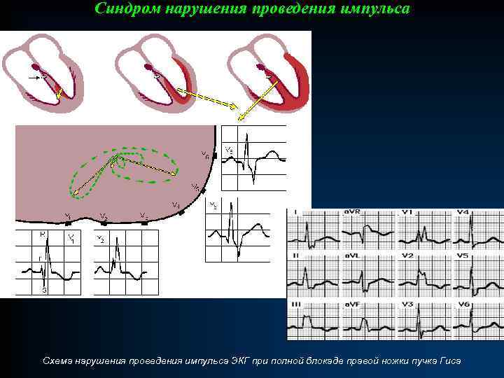 Аномальная экг. Нарушение проведения импульса ЭКГ. Синдром нарушения проведения импульса. К нарушениям проведения импульса относятся:. Из сердца идут импульсы схема.