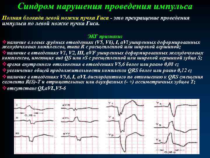 Синдром нарушения проведения импульса Полная блокада левой ножки пучка Гиса - это прекращение проведения