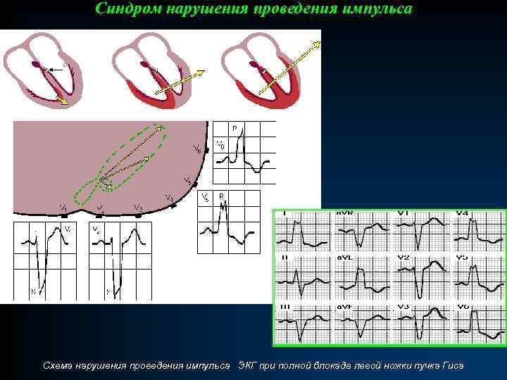 Аномальная экг