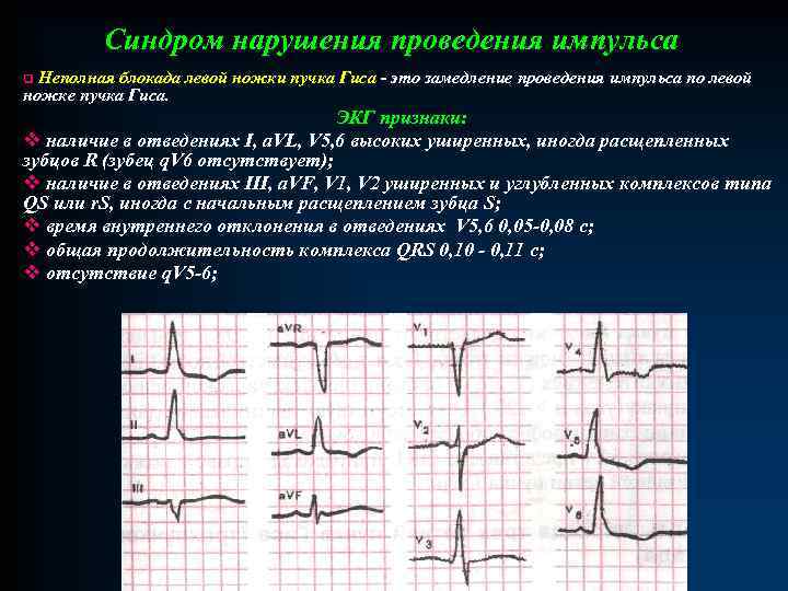 Неполная блокада пучка гиса на экг