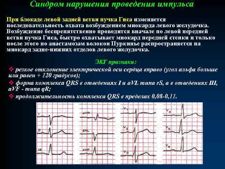 Синдром нарушения проведения импульса При блокаде левой задней ветви пучка Гиса изменяется последовательность охвата