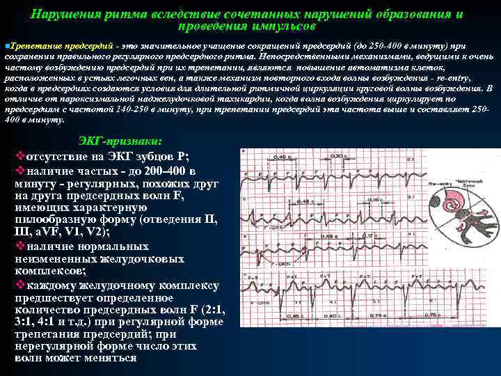 Патологии экг презентация