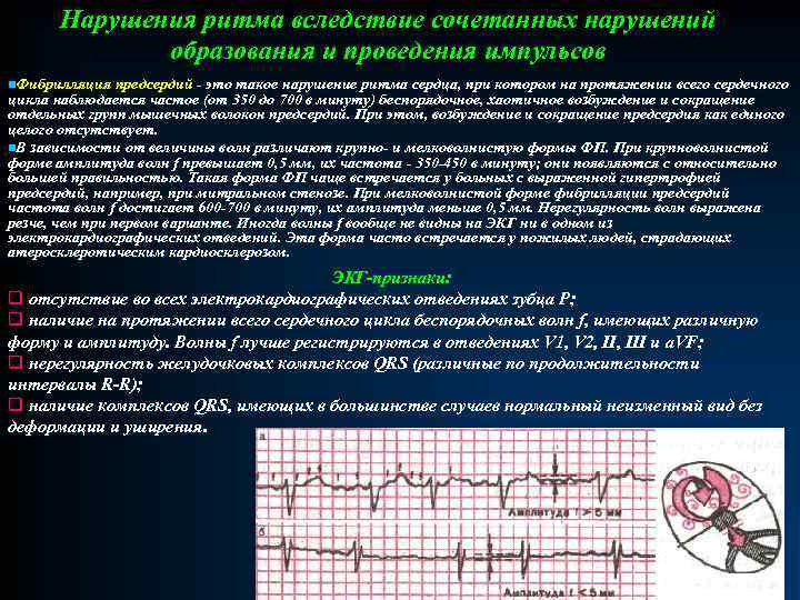 Патологии экг презентация