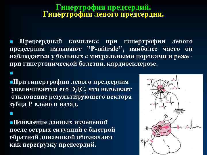 Патология левого предсердия. Гипертрофия левого предсерди. При гипертрофии левого предсердия. Гипертрофия левого предсердия заболевания. Гипертрофия левого предсердия болезни.