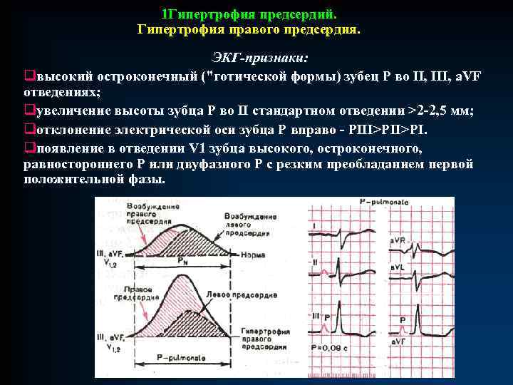 Патологии экг презентация