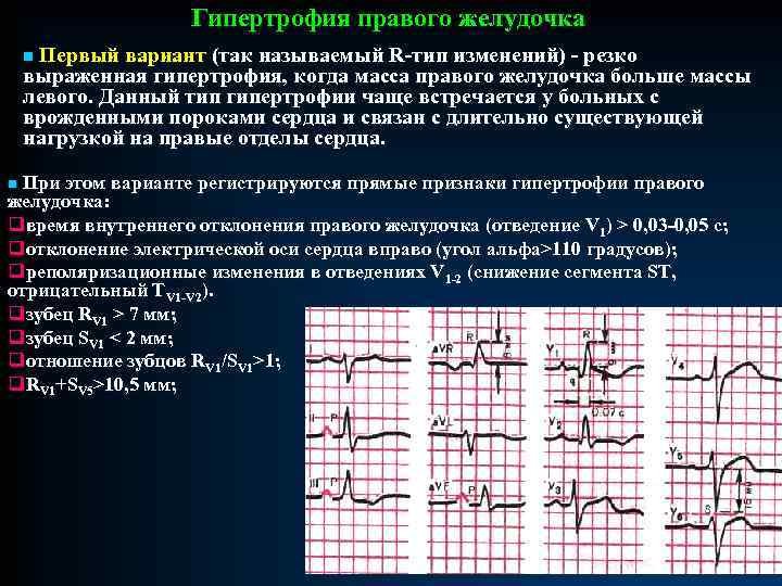 Гипертрофия правого желудочка n Первый вариант (так называемый R-тип изменений) - резко выраженная гипертрофия,