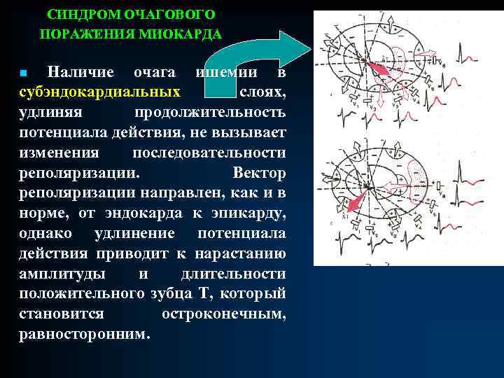 СИНДРОМ ОЧАГОВОГО ПОРАЖЕНИЯ МИОКАРДА n Наличие очага ишемии в субэндокардиальных слоях, удлиняя продолжительность потенциала