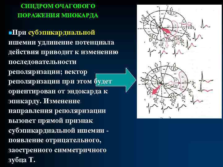 СИНДРОМ ОЧАГОВОГО ПОРАЖЕНИЯ МИОКАРДА n. При субэпикардиальной ишемии удлинение потенциала действия приводит к изменению