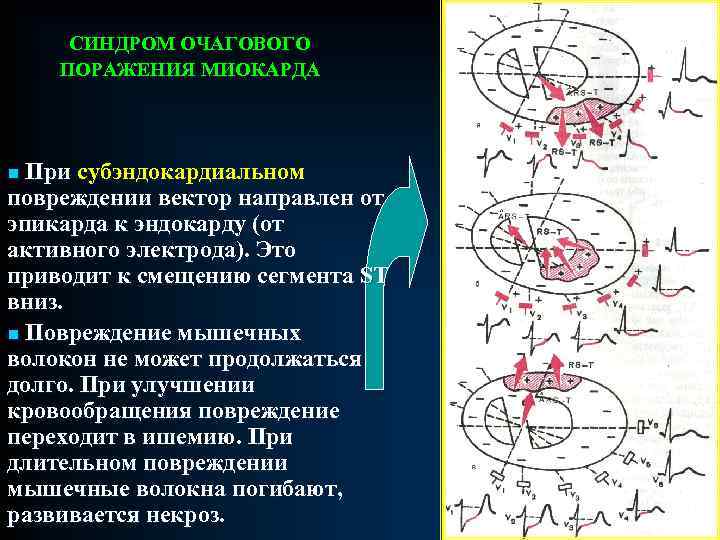 Патологии экг презентация