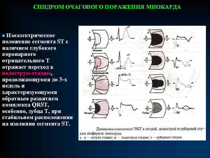 СИНДРОМ ОЧАГОВОГО ПОРАЖЕНИЯ МИОКАРДА n Изоэлектрическое положение сегмента ST с наличием глубокого коронарного отрицательного